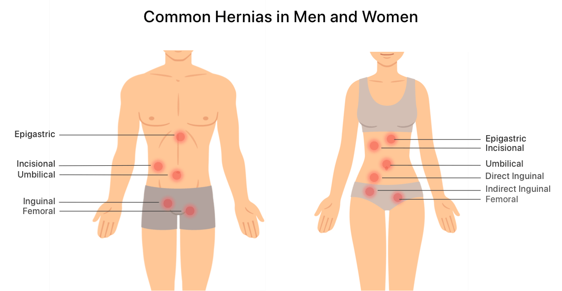 A hernia occurs when part of your insides bulges through an opening or weakness in the muscle or tissue barrier that contains it.