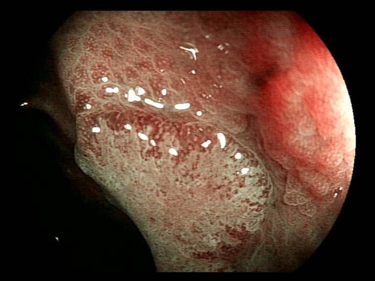 Ver esta lesión (vía <a href="/espeum/">Esperanza Ulloa Márquez</a>) y acordarte de lo que puedes llegar a aprender sobre diagnóstico óptico en lesiones de colon #LODIPstudy #TODearlyCRC <a href="/ignasipuigc/">Ignasi Puig 🩺</a> <a href="/joaopseixas/">João da Costa Seixas</a> <a href="/goesgroup/">GOES research group Althaia</a> 

Diría que hay NPG... ¿Qué os parece?
1/2