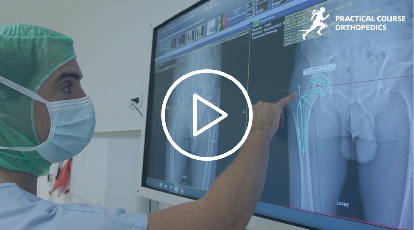 Minimally invasive posterior total hip replacement : 🎥 Watch the full procedure performed by Nicolas Reina!
➡️ bit.ly/3KWq3FW
#PCO23 #clinicalcase #orthopedics #hipsurgery #hipremplacement