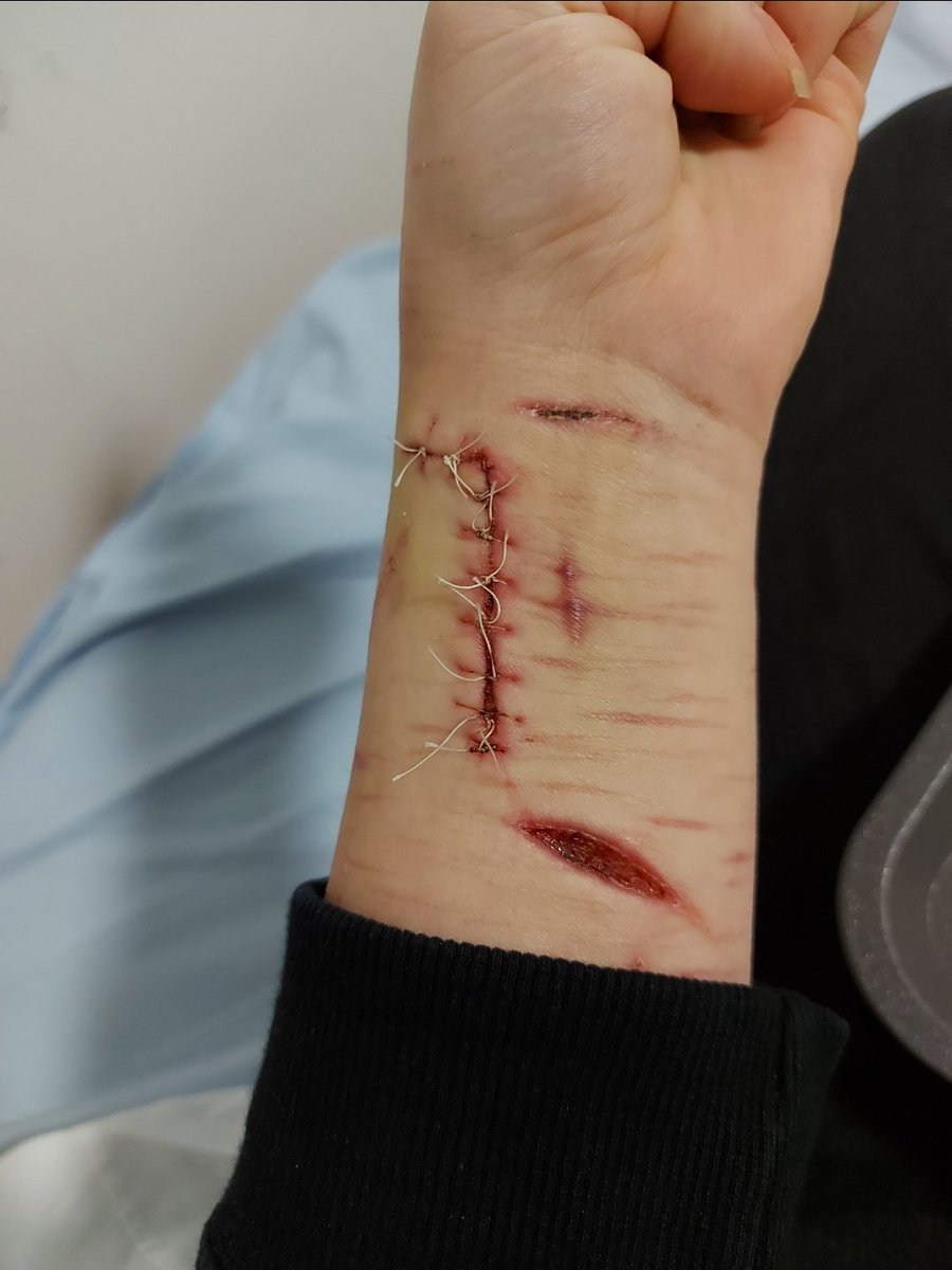 willowisdead234's tweet photo. Muscle!! The first pic is the only one i have of my first cut to muscle. I didnt even realise it was muscle until a nurse got shocked and told me... and then it got stitched https://t.co/2XDiZjwqKI