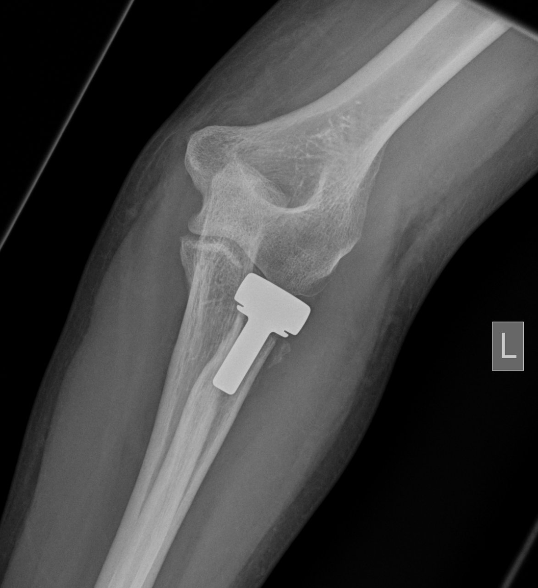 ORTHO REVIEW on Twitter "Q. When performing radial head replacement