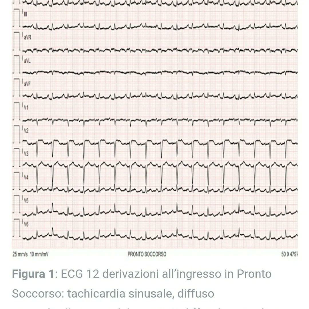 💡 Shock cardiogeno come prima manifestazione di cardiotossicità indotta da antracicline 💡

🧠A cura di: Cristina Conte, Alessia d’Aiello, Francesco Cribari, Marco del Buono, Gianluigi Saponara, Cristina Aurigemma, Daniela Pedicino, Tommaso Sanna

italiancot.it/2023/04/14/sho…