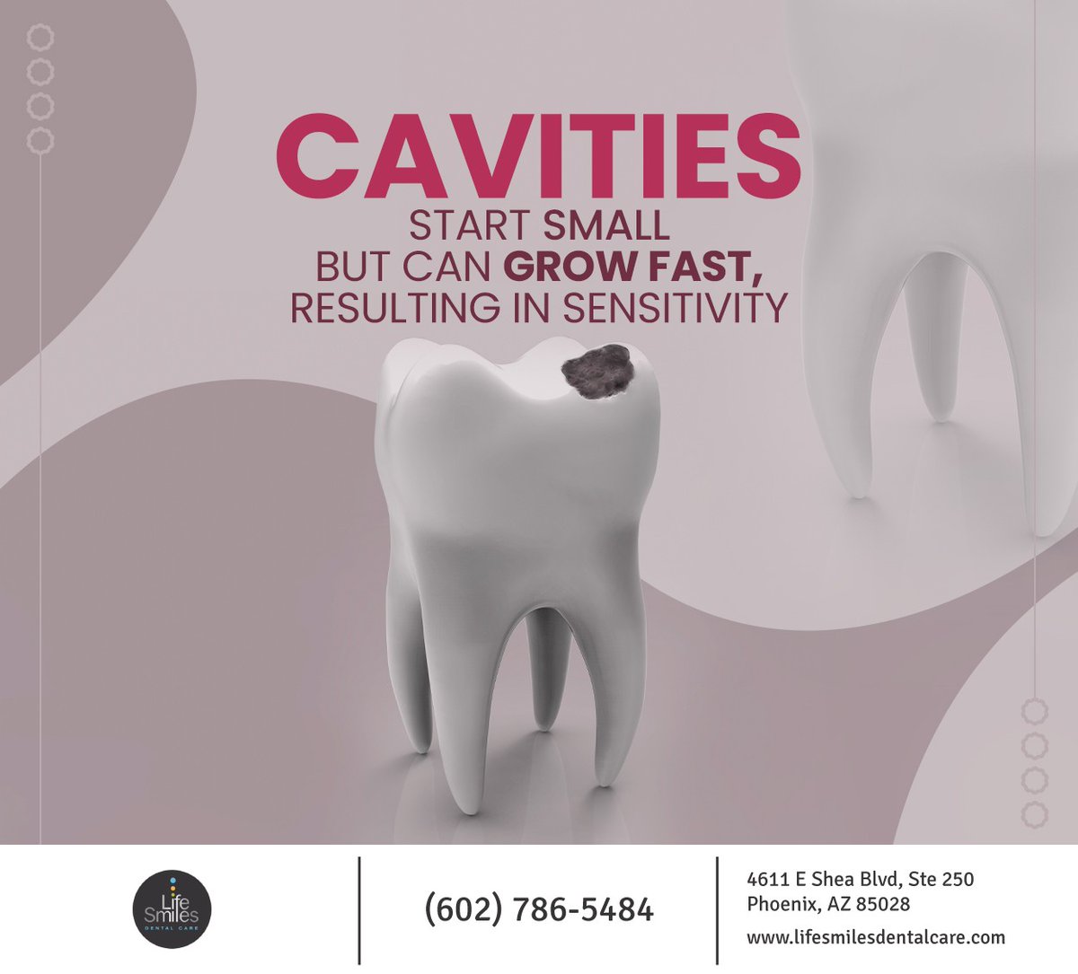 Poor #oralhygiene can lead to tooth #decay which may go unnoticed, eventually leading to cavities that will require a filling. Schedule an appointment at lifesmilesdentalcare.com if you notice any cavities in your teeth.
