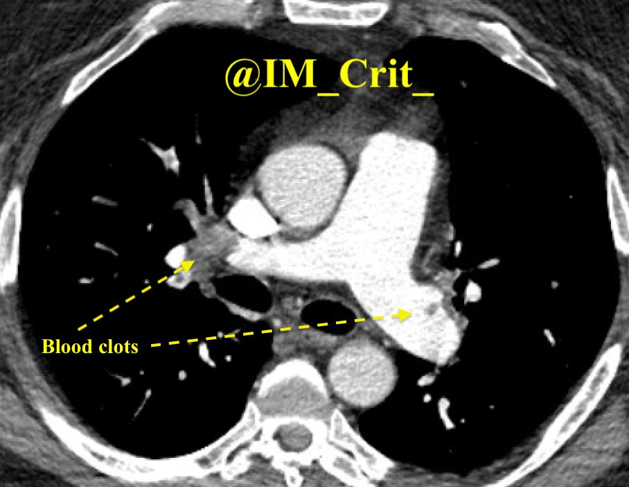 IM_Crit_'s tweet photo. ICU stories: 42 yo🙍🏻‍♀️w HTN / OSA-obesity (BMI: 40) presented to the ED w dyspnea/cough for 1 day. Vitals: bp 137/68, hr 82, rr 18, sat 88% (improved to 97% w 4 l/m nasal cannula). Labs: trop 0.4 (normal <0.1), BNP 1000 (normal <120), d-dimer: 3000. CT chest: acute bilateral PE https://t.co/yn3P3uBgmy