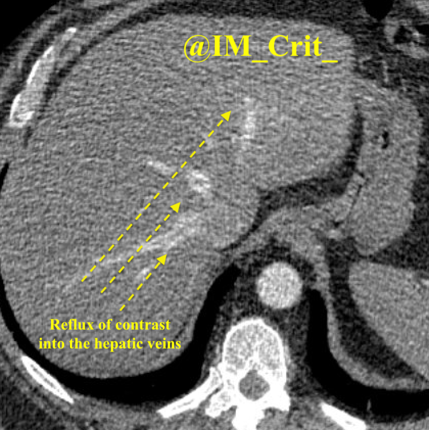 IM_Crit_'s tweet photo. ICU stories: 42 yo🙍🏻‍♀️w HTN / OSA-obesity (BMI: 40) presented to the ED w dyspnea/cough for 1 day. Vitals: bp 137/68, hr 82, rr 18, sat 88% (improved to 97% w 4 l/m nasal cannula). Labs: trop 0.4 (normal <0.1), BNP 1000 (normal <120), d-dimer: 3000. CT chest: acute bilateral PE https://t.co/yn3P3uBgmy