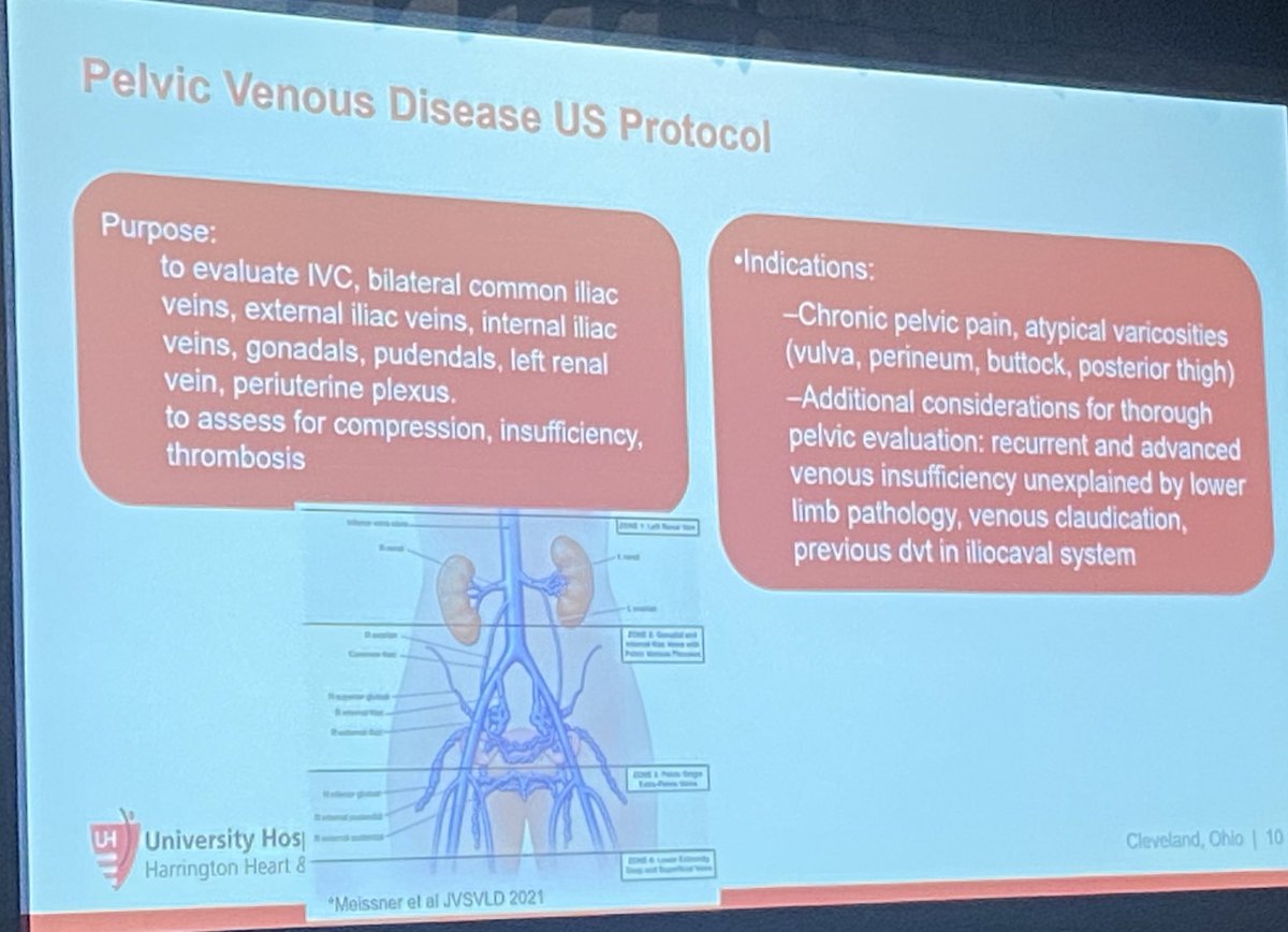 heatherlgornik's tweet photo. .@KaremHarthMD reviews core elements of duplex protocols for assessment of pelvic venous insufficiency @HarringtonHVI @UHVascular https://t.co/sRE3YKIc4w