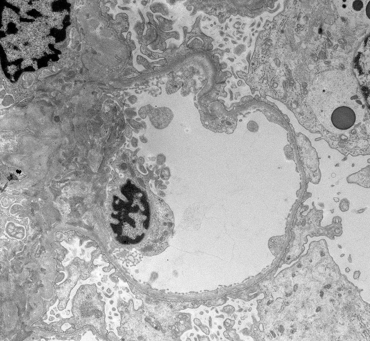 Post-txp recurrence of a primary 'FSGS'(<1 wk). Normal glomeruli with diffuse podocyte foot process effacement. Good illustration that all diffuse podocytopathies likely start off looking like 'minimal change' early on. Better terminology is needed #renalpath #PathTwitter