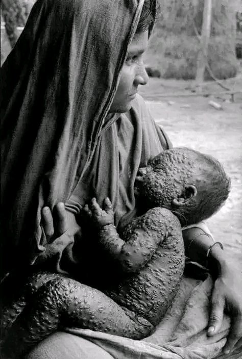 HistoryOfBangla's tweet photo. The photo was taken on June 14, 1972 by British photographer Chris Steele- Perkins.

A helpless mother sits with a child suffering from smallpox.

A mother sitting with a dying child in her arms - there seems to be nothing more terrible in the world. https://t.co/0aVFEcWAhp