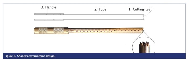 Shaeer’s Cavernotome for Penile Prosthesis Implantation in Scarred Corpora Cavernosa 

Osama Shaeer et al. 

#penileimplantinfection #priapism #penileprosthesis #cavernotome #corporalscarring #corporalfibrosis
#PubMed #UroSoMe #MedTwitter #Urology 

urologyresearchandpractice.org