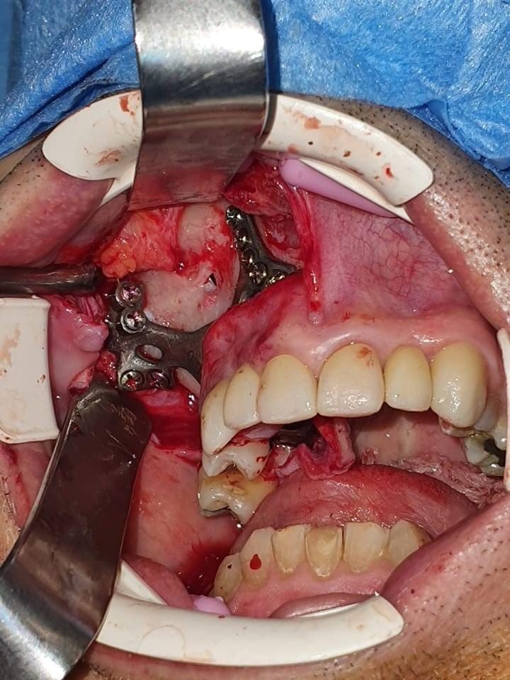 boneeasy's tweet photo. Graftless same day teeth #implantizecompact ask your dentist https://t.co/eluthIPbND