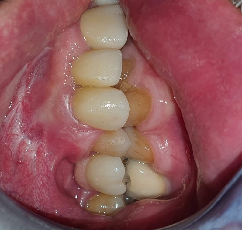 boneeasy's tweet photo. Graftless same day teeth #implantizecompact ask your dentist https://t.co/eluthIPbND