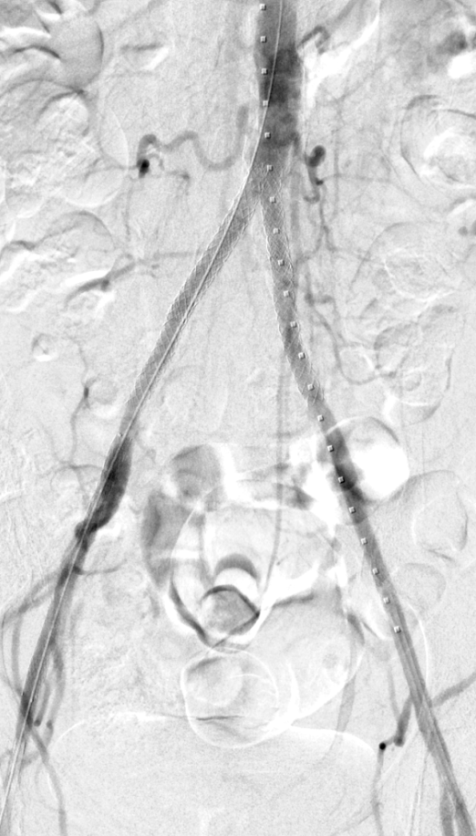 Sasha Ushinsky (@sushinsk) on Twitter photo Two occlusions - One Day. Bilateral iliac occlusions with distal aortic stenosis in CLTI. Kissing stent graft reconstruction after IVL at <a href="/MIRimaging/">WashUMedMIR</a> <a href="/WashUIR/">Mallinckrodt IR</a> . Appreciate the advice from <a href="/CarlosGuevaraIR/">Carlos Guevara MD, FSIR</a> Two occlusions - One Day. Bilateral iliac occlusions with distal aortic stenosis in CLTI. Kissing stent graft reconstruction after IVL at <a href="/MIRimaging/">WashUMedMIR</a> <a href="/WashUIR/">Mallinckrodt IR</a> . Appreciate the advice from <a href="/CarlosGuevaraIR/">Carlos Guevara MD, FSIR</a>