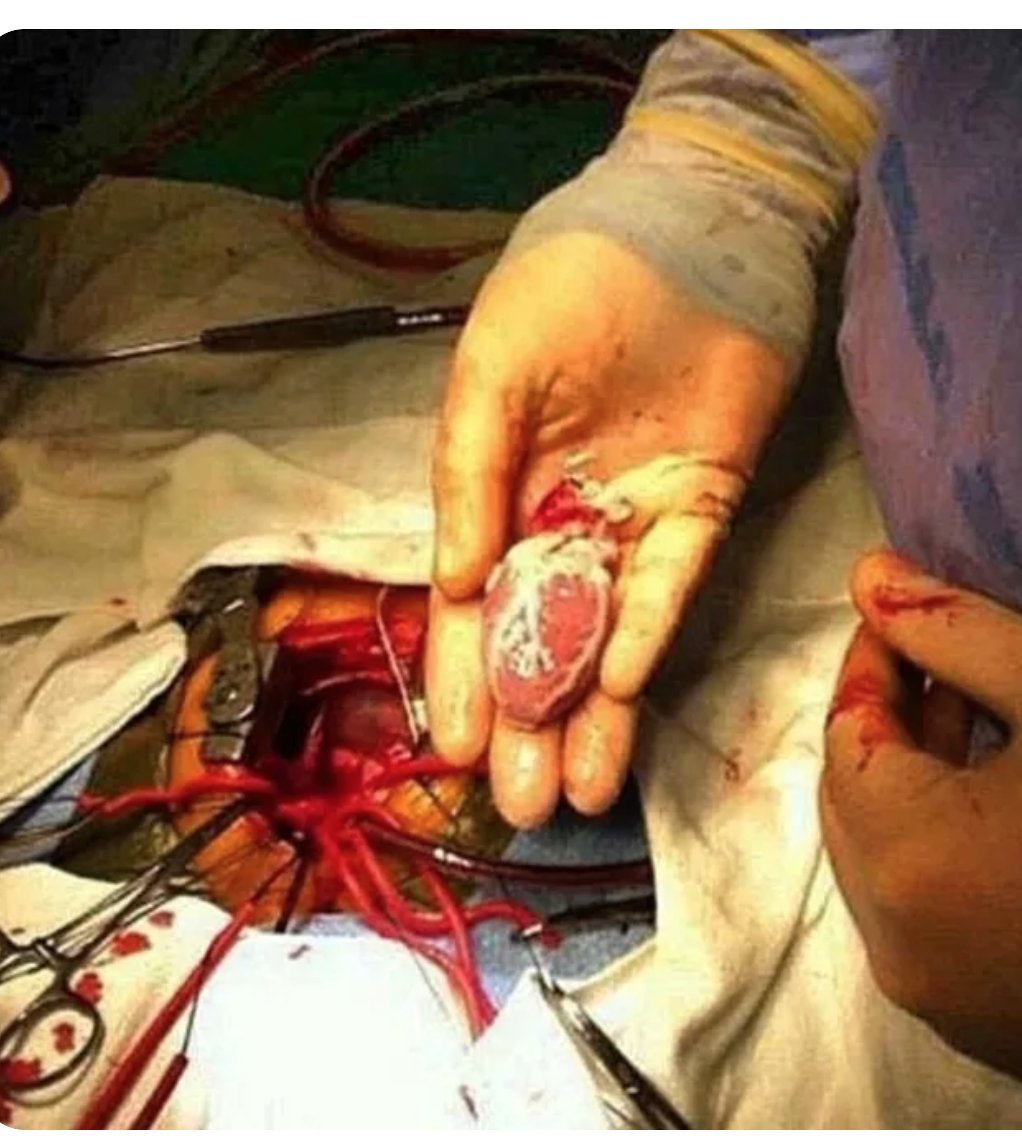 OGdukeneurosurg's tweet photo. pediatric heart transplant https://t.co/LCeDuOcxLa