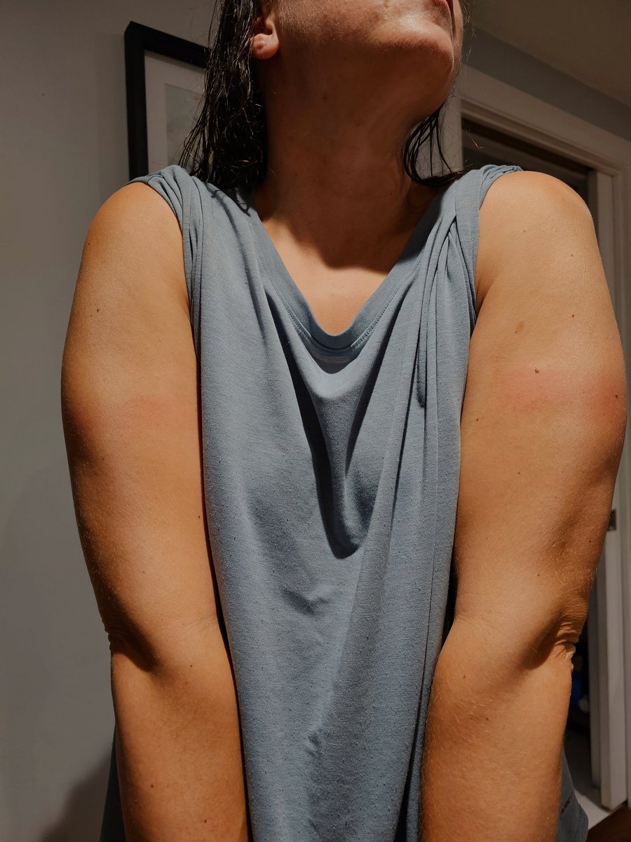 aviation_wx's tweet photo. Note to self... next time you apply sunscreen before a ride, account for how much the sleeves will rise up with the tri bars. 🤦‍♀️☀️ #nicetan https://t.co/uZAlY1j2JP