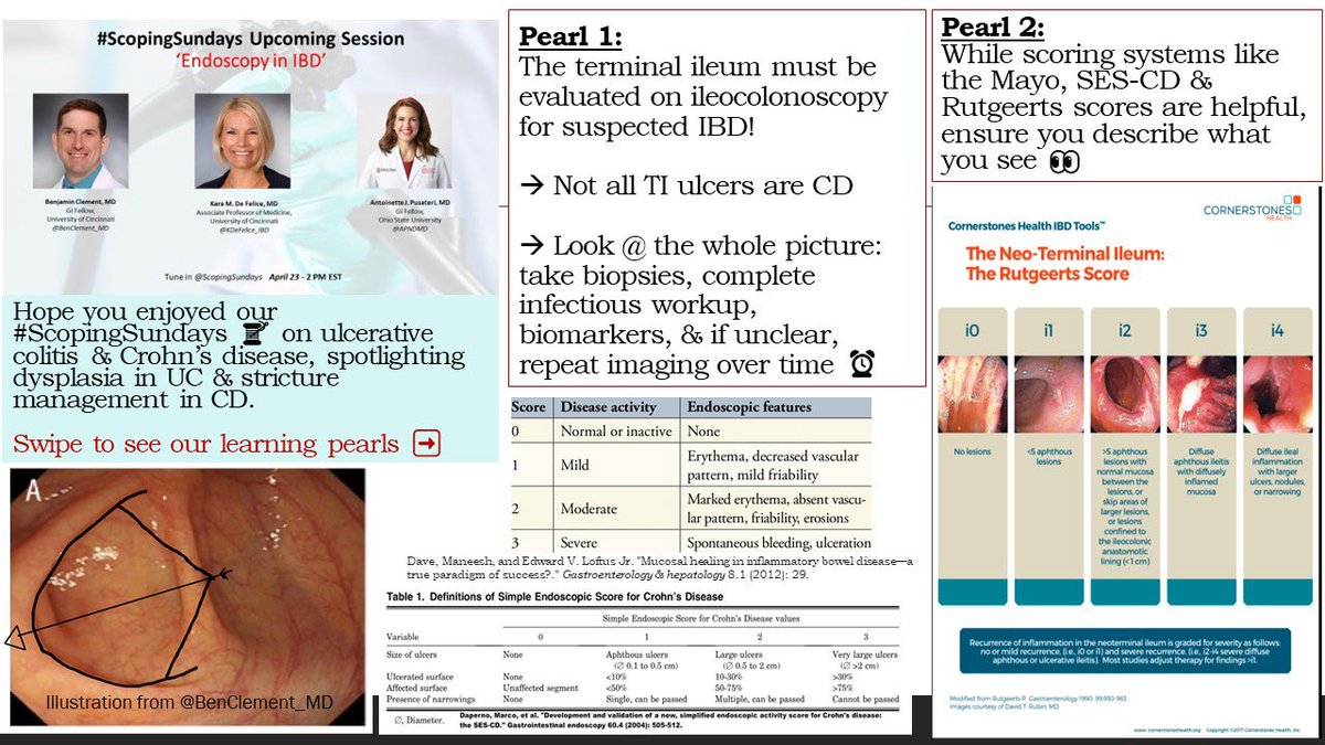 ScopingSundays's tweet photo. Missed out on the🔥🔥🔥#ScopingSundays discussion this past weekend on “Endoscopy in #IBD”?

Check out the #ScopingSummary from the interactive discussion led by @KDeFelice_IBD, @BenClement_MD &amp; @APNDMD !

Special thanks to @APNDMD for the summary! https://t.co/Lmsjy5d7EX