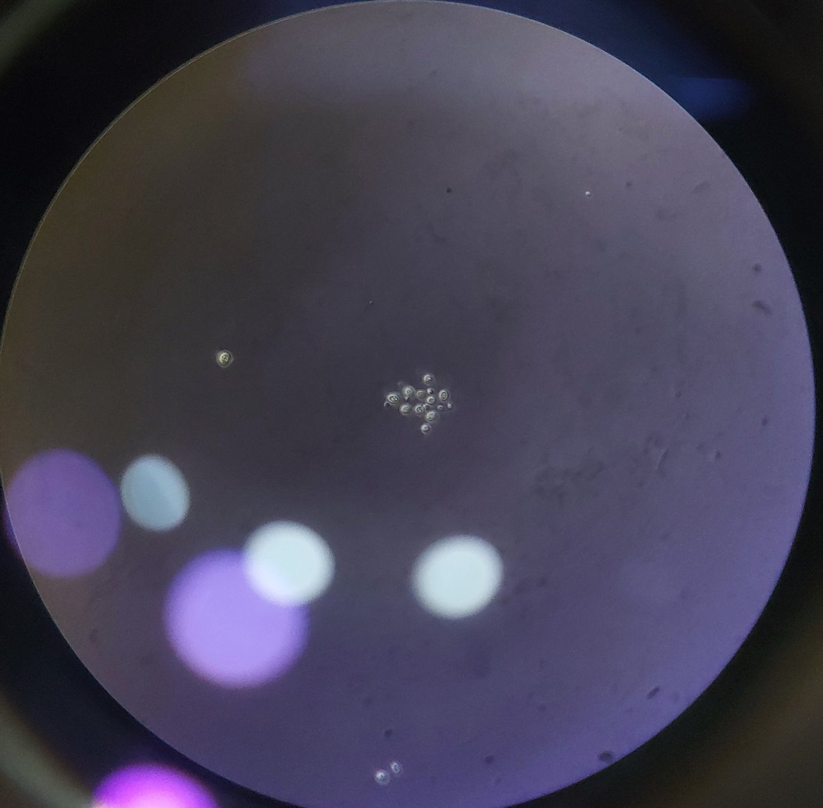 #IDpath #PathTwitter 
Cryptococcus
✒️India ink preparation
✒️ Budding yeast
✒️ Encapsulated
✒️Cocci of varying sizes
✒️ Immunosuppressed patients
#MedicalMicrobiology 
#medtwitter