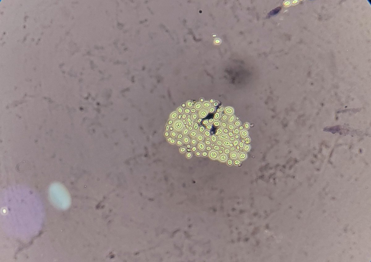 padmapathology1's tweet image. #IDpath #PathTwitter 
Cryptococcus
✒️India ink preparation
✒️ Budding yeast
✒️ Encapsulated
✒️Cocci of varying sizes
✒️ Immunosuppressed patients
#MedicalMicrobiology 
#medtwitter