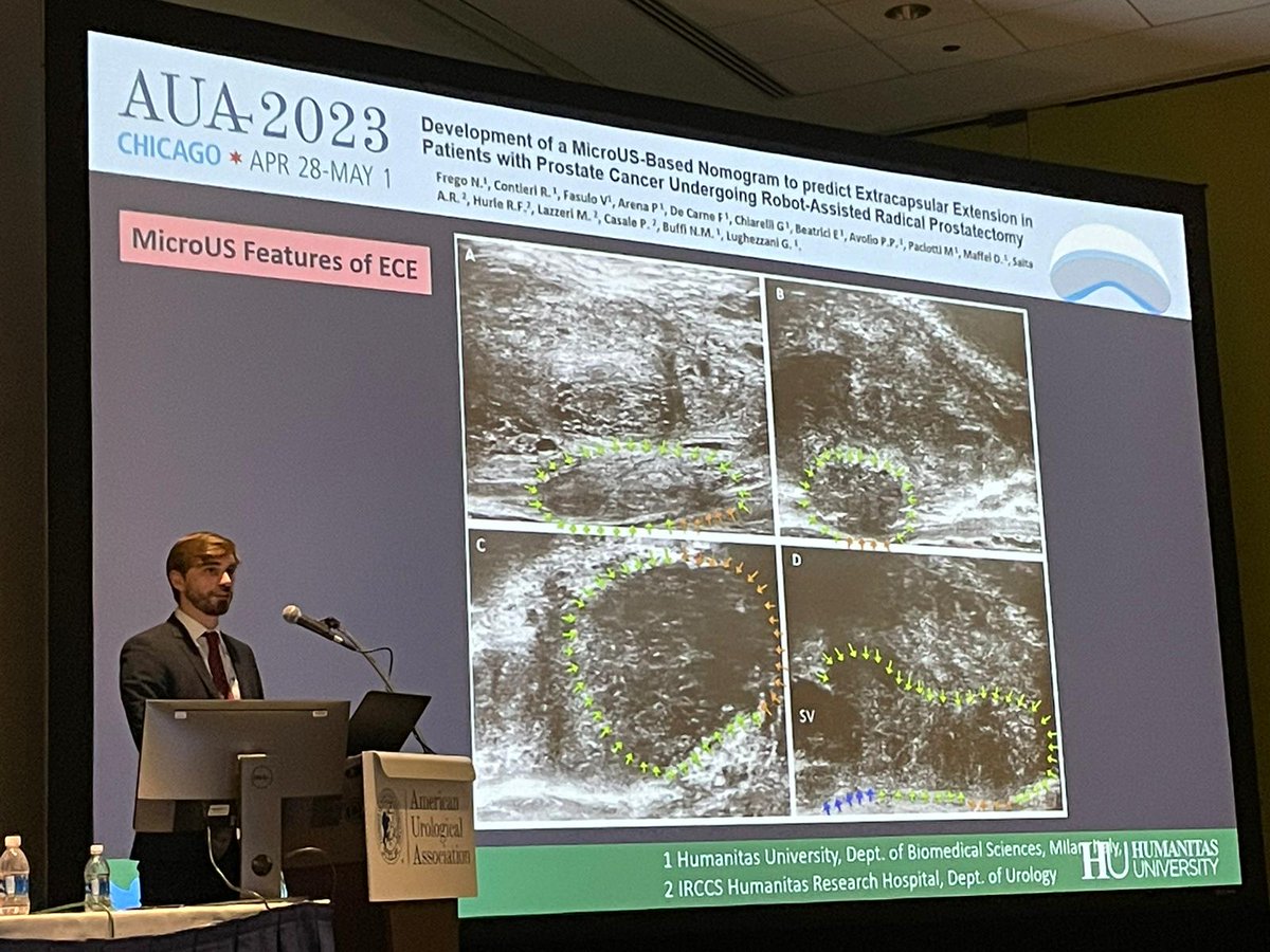 ExactImaging's tweet photo. Great talk at #AUA2023 by @DavideMaffei_MD  from @HumanitasMilano, on Extra Prostatic Extension of #prostatecancer as visualised with #Microultrasound @ExactImaging @FocalOneHIFU @EDAPTMS 
#SeeCharacterizeTarget https://t.co/FLEVVEK7kS