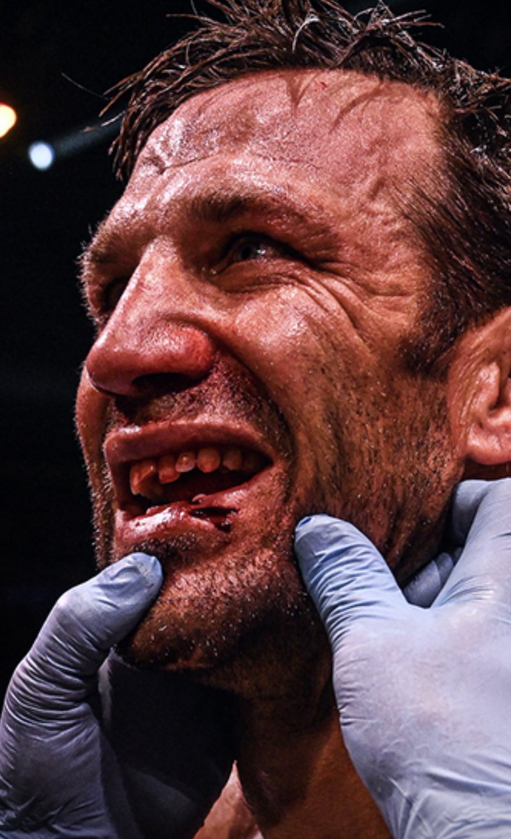 BorrachinhaMMA's tweet photo. OMG luke will have a hard time kissing guys now. at least he has a hard chin with a toothless mouth. Perry did it again 👏 . Boxing is so different than mma , especially without gloves dude https://t.co/8oc5thnpfg