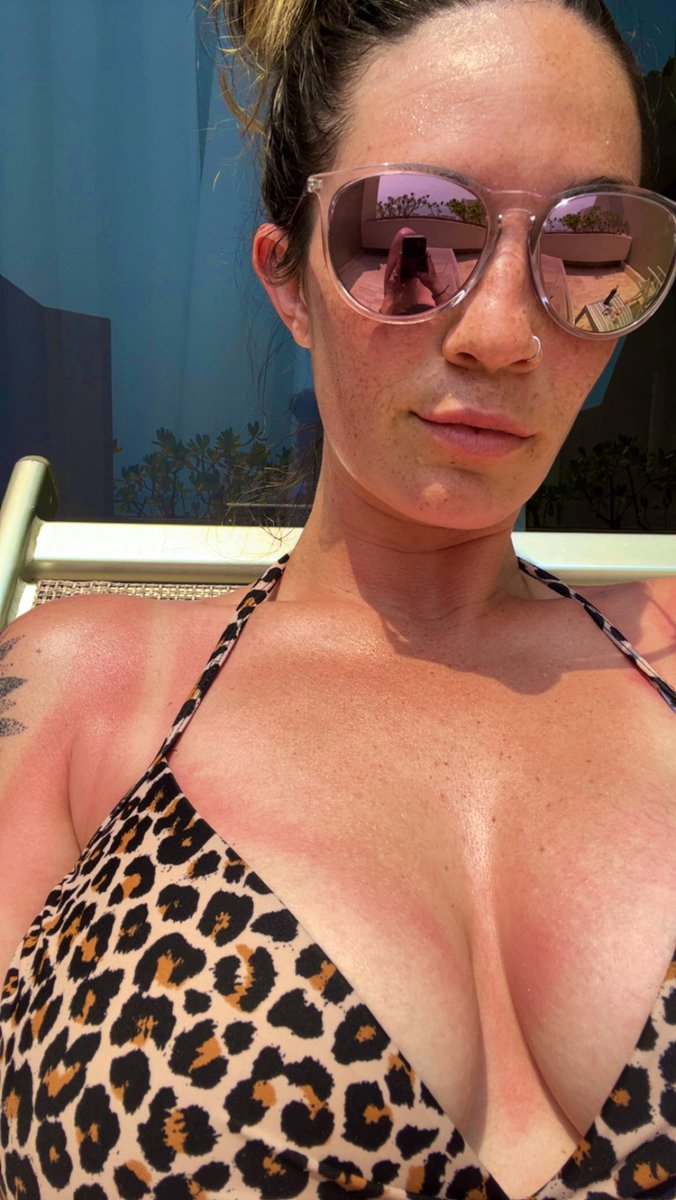 BrunetteBabe_95's tweet photo. I got the weirdest sunburns the first day 😂 https://t.co/U05XZQbgaR