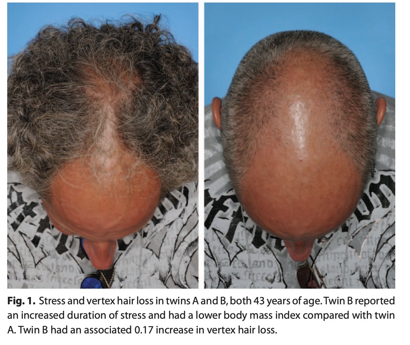 Update more than 110 exercise hair loss latest dedaotaonec