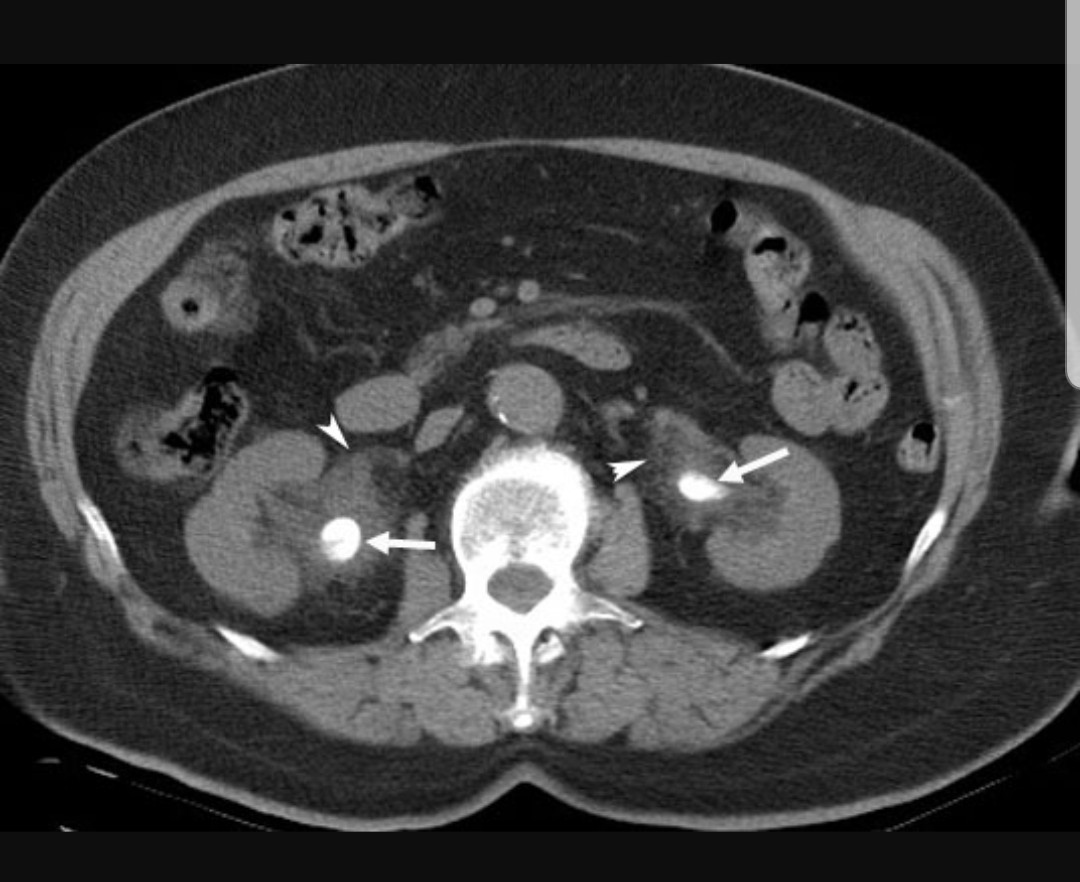 Daniele Castellani (@d_castellani) on Twitter photo Bilateral kidney stones. Staged procedures or same sitting bilateral #RIRS? If you are interested, you can find some indications in our latest paper. We ❤ #endourology <a href="/EurUrolOpen/">European Urology Open Science</a> #Urosome
authors.elsevier.com/sd/article/S26… Bilateral kidney stones. Staged procedures or same sitting bilateral #RIRS? If you are interested, you can find some indications in our latest paper. We ❤ #endourology <a href="/EurUrolOpen/">European Urology Open Science</a> #Urosome
authors.elsevier.com/sd/article/S26…