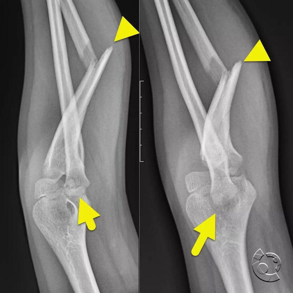 CincyKidsRad's tweet photo. AP (image 1) and lateral (image 2) radiograph focused at the elbow shows a fracture of the mid ulna (arrowhead) and dislocation of the proximal radius (arrow) consistent with a Monteggia fracture. A Monteggia fracture is caused by a blow to the forearm w… https://t.co/pU4GyYK0Vm https://t.co/RkKNn8onMZ
