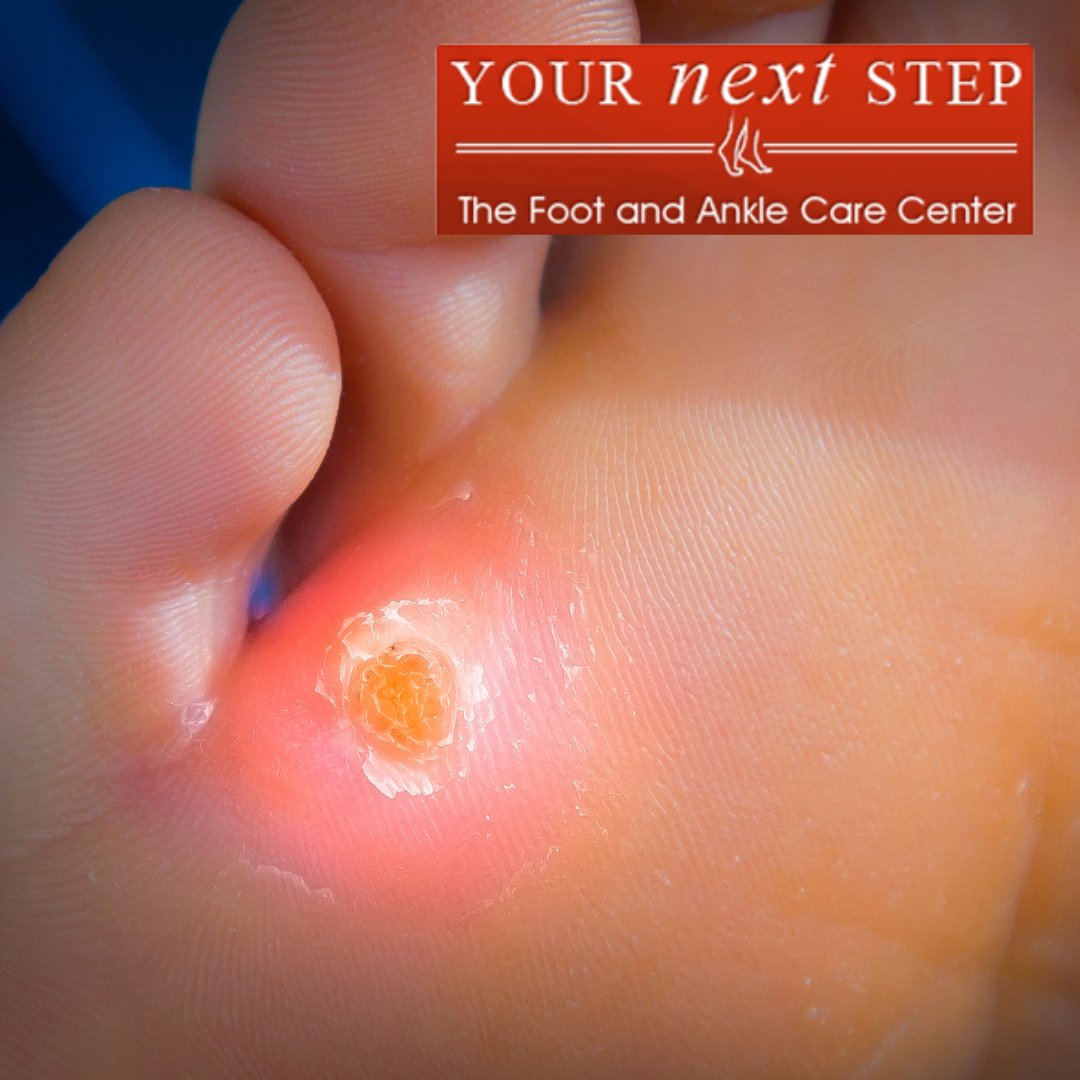 Corns and calluses are common conditions we see at Your Next Step. While some people treat them at home, today we're sharing 5 ways they can be professionally treated to reduce the risk of infection: bit.ly/3H3P67A