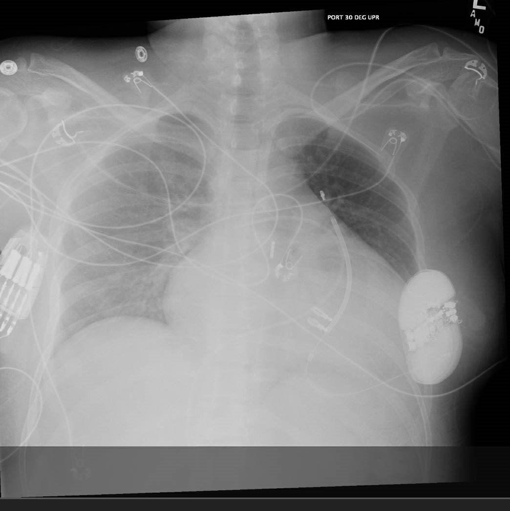 LAVA is 🔥new cool way to get to 🫀transplant. Our patient, SCAI D sliding on IABP + inotropes, 13 hrs on LAVA, diuresed, normal lactate and filling pressures @SammyElmariahMD @RichardChengMD @JasonWSmithMD @FiedlerAmy @Sam_Brusca @ConnorObrienMD @ChrisBarnettMD @UCSFCardiology