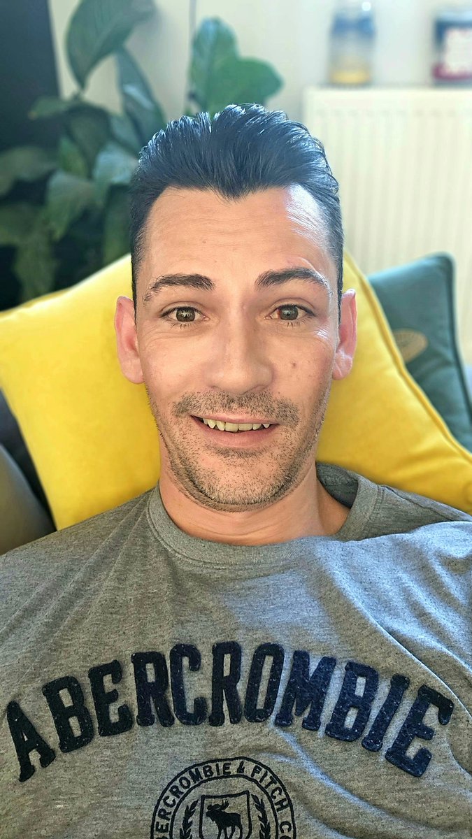 TheAdamMcGibbon's tweet photo. Took the plunge and had laser eye surgery on Monday! Had Lasik iDesign with @OpticalExpress. Amazing people, fantastic surgical team, and awesome results. Vision is perfect and I couldn't be happier. Photos taken day 1&4
#Opticalexpress #lasereyesurgery #lasik #idesign https://t.co/Iveuqoe4Px