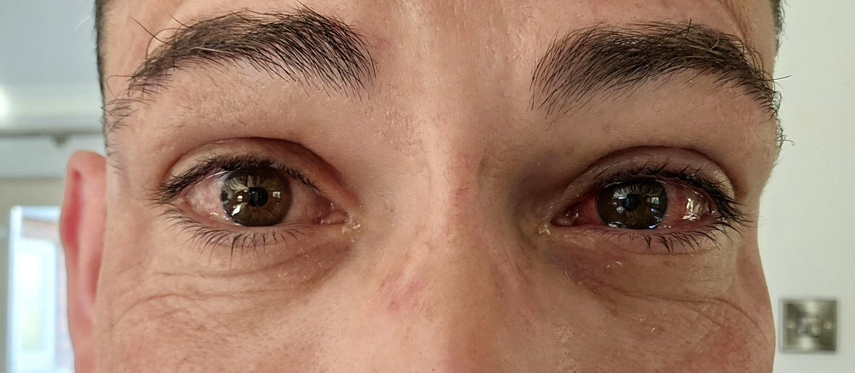 TheAdamMcGibbon's tweet photo. Took the plunge and had laser eye surgery on Monday! Had Lasik iDesign with @OpticalExpress. Amazing people, fantastic surgical team, and awesome results. Vision is perfect and I couldn't be happier. Photos taken day 1&4
#Opticalexpress #lasereyesurgery #lasik #idesign https://t.co/Iveuqoe4Px