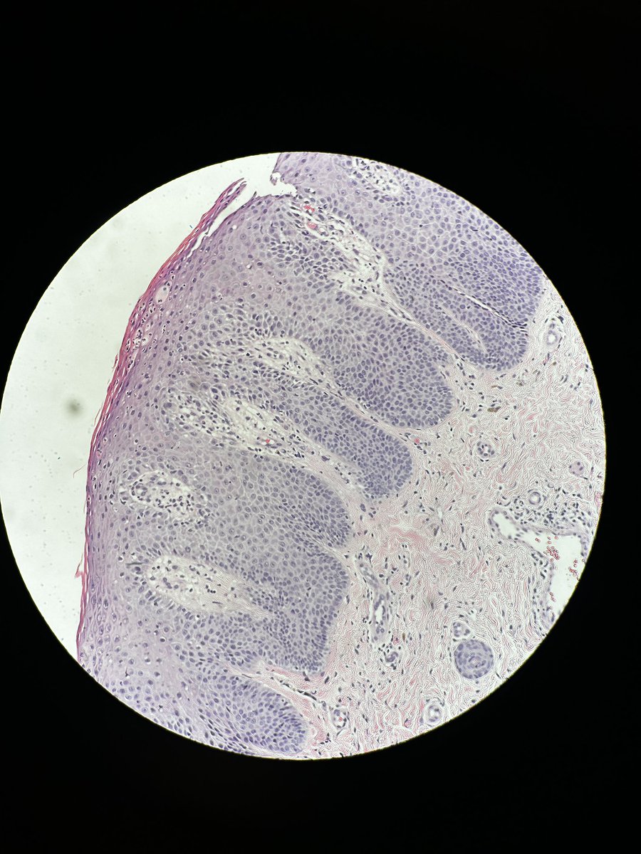 Path4People's tweet photo. ๐ต๏ธโโ๏ธ๐ง It's time for #casestudyfriday! This week we're looking at a case of a 27-year-old woman with a mysterious rash on her forearm. Can you help us solve the mystery? #path4people
Answer:
https://t.co/Awy7vTfxlO https://t.co/9EAEsWm6iK