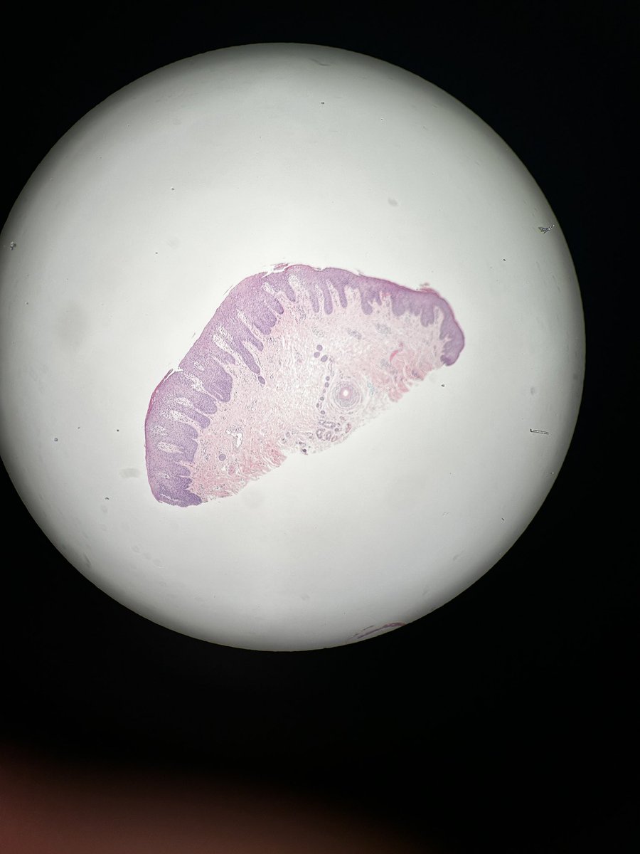 Path4People's tweet photo. ๐ต๏ธโโ๏ธ๐ง It's time for #casestudyfriday! This week we're looking at a case of a 27-year-old woman with a mysterious rash on her forearm. Can you help us solve the mystery? #path4people
Answer:
https://t.co/Awy7vTfxlO https://t.co/9EAEsWm6iK
