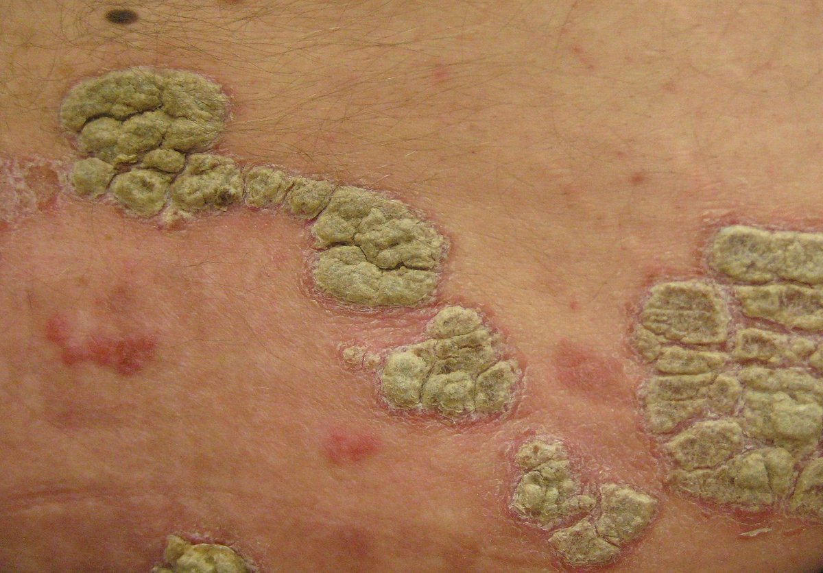 Path4People's tweet photo. ๐ต๏ธโโ๏ธ๐ง It's time for #casestudyfriday! This week we're looking at a case of a 27-year-old woman with a mysterious rash on her forearm. Can you help us solve the mystery? #path4people
Answer:
https://t.co/Awy7vTfxlO https://t.co/9EAEsWm6iK