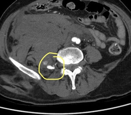 VirTauli's tweet photo. CASE REPORT 📢

Paciente con hematoma retroperitoneal con imagen de pseudoaneurisma post discectomía percutánea. Condiciona hipotensión. https://t.co/wdREwPOlJ4