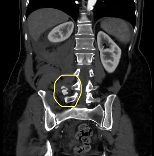 VirTauli's tweet photo. CASE REPORT 📢

Paciente con hematoma retroperitoneal con imagen de pseudoaneurisma post discectomía percutánea. Condiciona hipotensión. https://t.co/wdREwPOlJ4