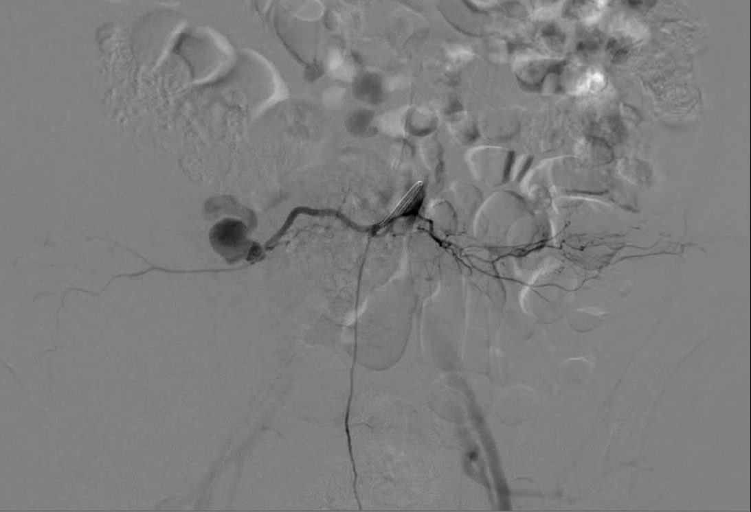 VirTauli's tweet photo. CASE REPORT 📢

Paciente con hematoma retroperitoneal con imagen de pseudoaneurisma post discectomía percutánea. Condiciona hipotensión. https://t.co/wdREwPOlJ4