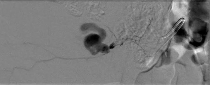 VirTauli's tweet photo. CASE REPORT 📢

Paciente con hematoma retroperitoneal con imagen de pseudoaneurisma post discectomía percutánea. Condiciona hipotensión. https://t.co/wdREwPOlJ4