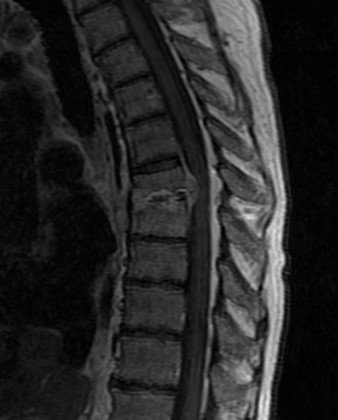 🆕 Case # 127:   
➡️ Back pain
➡️ Diagnosis?
➡️ Reply by Friday, 5/5!      

#MSKRad #MedTwitter #RadRes #RadFellows