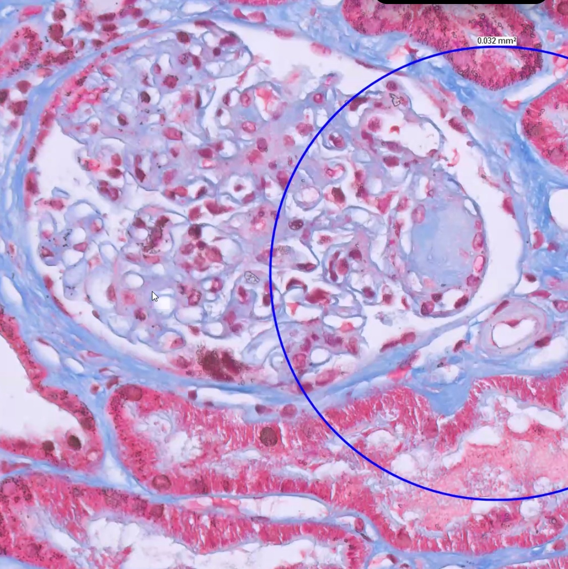 ssfarouk's tweet image. Kimmelstiel-Wilson nodule in a pt w diabetes, Masson’s trichrome stain

#KidneyPath