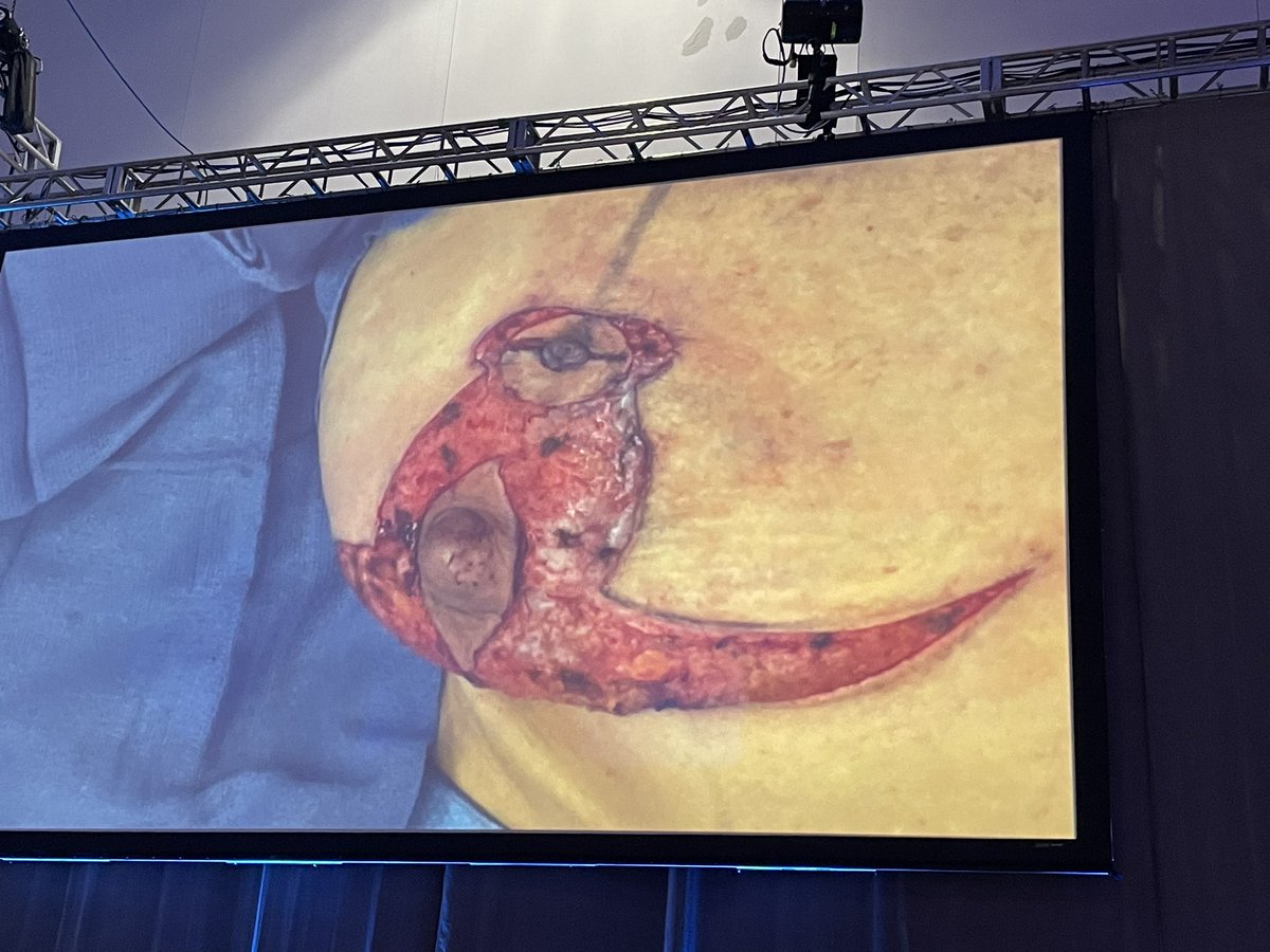 ASBrS's tweet photo. Novel approach to centrally located breast cancer resection. Perfect use of oncoplastic techniques for these challenging cases. Great how I do it video by Dr Stephanie Young #ASBrS23 https://t.co/cPvQkKzHxg