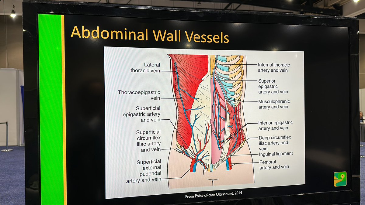 Ultrasound guided Paracentesis workshops at #IM2023 <a href="/ACPIMPhysicians/">ACP</a> Remember to scan for vessels, it’s not just the epigastrics!