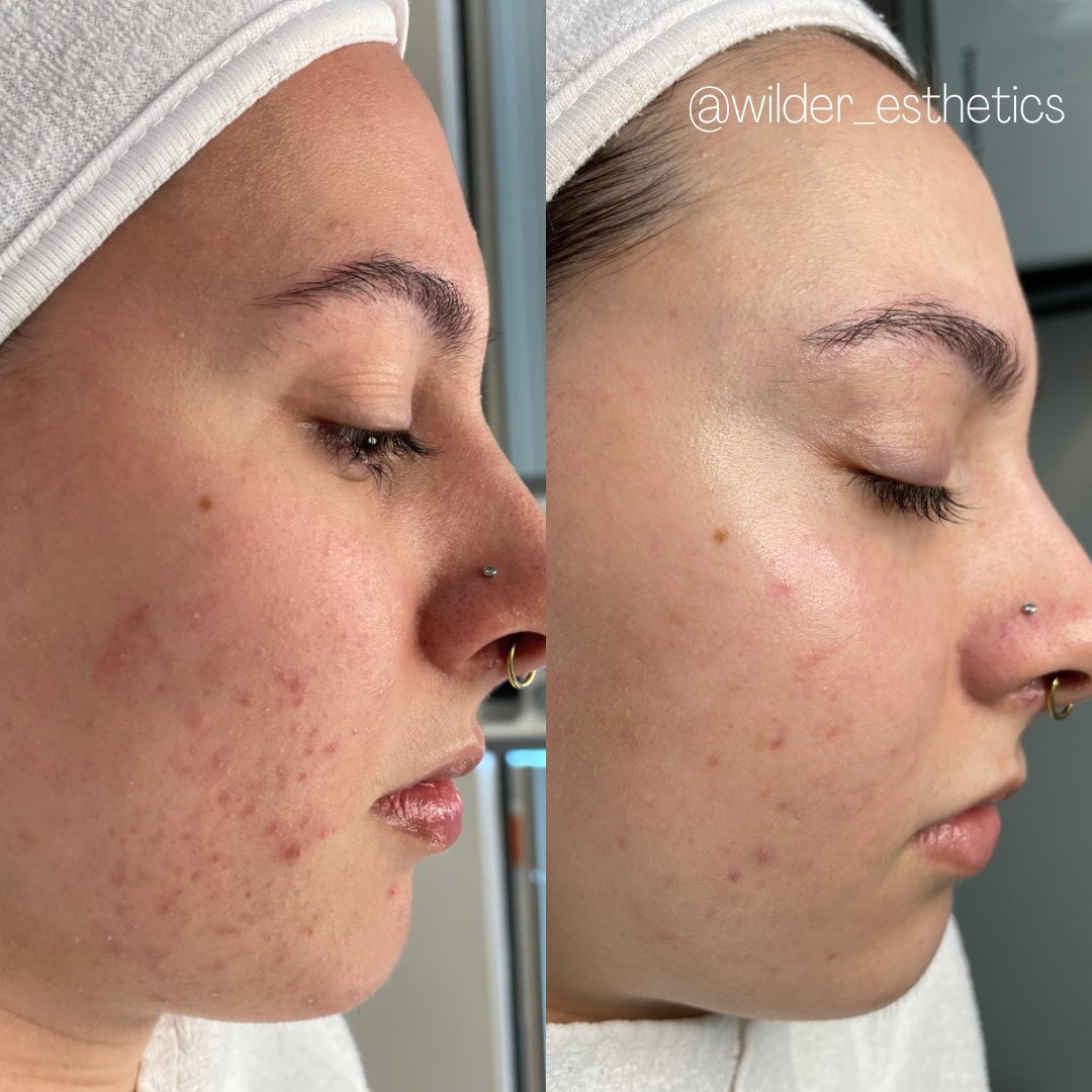 themaggieshow_'s tweet photo. hey!!! portland mutuals!! if you are looking for a covid-informed esthetician, my friend Holly has had many clients cancel due to her wearing a KN95 at work. she’s an acne specialist and an angel of a human! her Instagram is @ wilder_esthetics. here’s some of her work! pls book!! https://t.co/SoW0wXEwL3