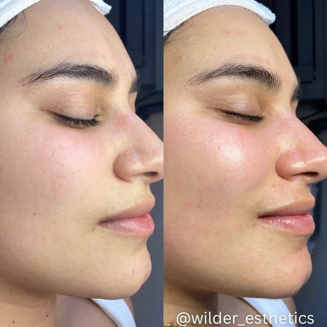 themaggieshow_'s tweet photo. hey!!! portland mutuals!! if you are looking for a covid-informed esthetician, my friend Holly has had many clients cancel due to her wearing a KN95 at work. she’s an acne specialist and an angel of a human! her Instagram is @ wilder_esthetics. here’s some of her work! pls book!! https://t.co/SoW0wXEwL3