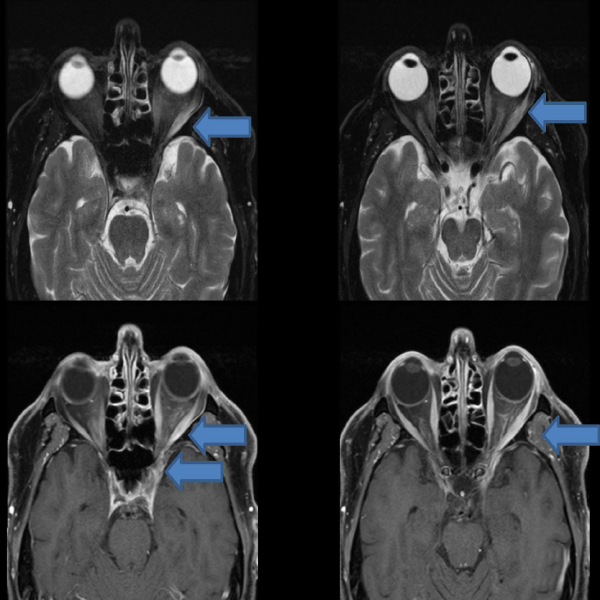 Ophthalmology Eponym of the Week: Tolosa-Hunt Syndrome refers to an extremely rare and painful ophthalmoplegia secondary to noninfectious inflammation of the cavernous sinus.
#ophthalmology #ophthotwitter #medtwitter