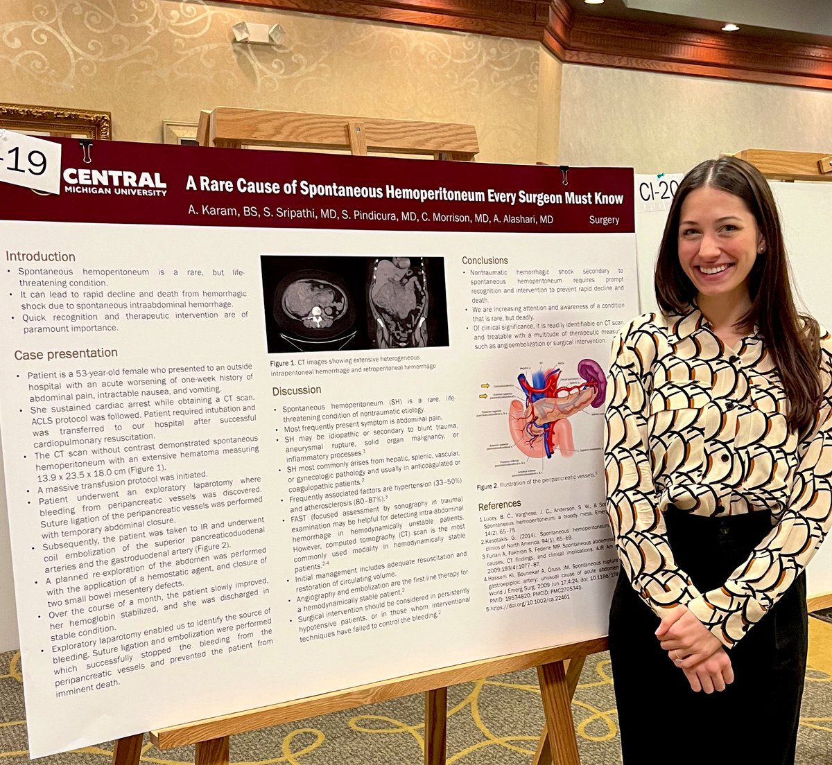 KaramAlessandra's tweet photo. Is spontaneous hemoperitoneum on your differential? Don’t forget that internal hemorrhage can happen without inciting factors! 

Enjoyed hearing all about the research my colleagues have been up to at today’s CMU research symposium. @CMU_Medicine https://t.co/OnKoIanuAx