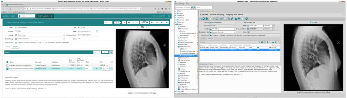 Thymbra_eHealth's tweet image. &quot;Working to deliver the best experience with the #GNUHealth Hospital Management, independently of the device/interface. 
The power of #OpenScience and  cooperation among the #LibreSoftware community&quot; #GNU @gnuhealth @TrytonSoftware  @OrthancServer 
Source: mastodon.social/@gnuhealth/110…