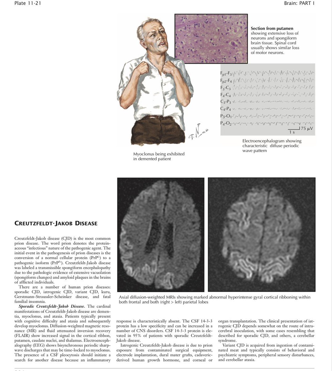 Oren Gottfried, MD on Twitter "CREUTZFELDTJAKOB DISEASE According to