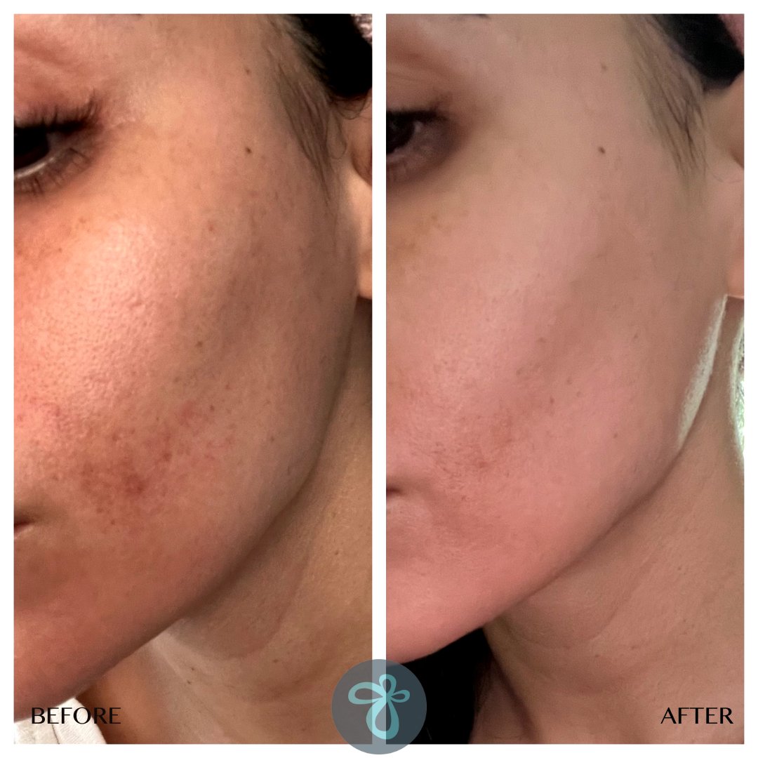 Check out these results from our new chemical peel with NO DOWNTIME! ✨🙌💎🙌✨ BioRepeel is not only an effective chemical peel that improves dark spots but is also infused with vitamins and antioxidants. ⚡✨💎✨⚡ Best of all there is no downtime, you will not ha...