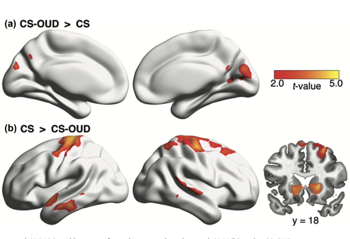 AJDAAJournal's tweet photo. Effects of current #smoking severity on brain gray matter volume in #OpioidUseDisorder – a voxel-based #morphometry study
Zhenhao Shi, @AnnaRChildress, @CorindeW et al
→ https://t.co/Iu85cRZU25
#CigaretteSmoking #GrayMatterVolume #VoxelBasedMorphometry #OpioidUse #MRI https://t.co/TDNuFHIh1R
